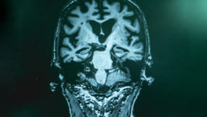 drug stocks alzheimer's disease with MRI